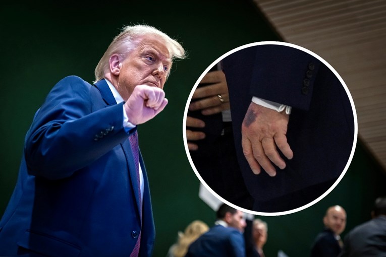 Trump ima jednostavno objašnjenje za modricu na ruci. Kaže da je od aspirina