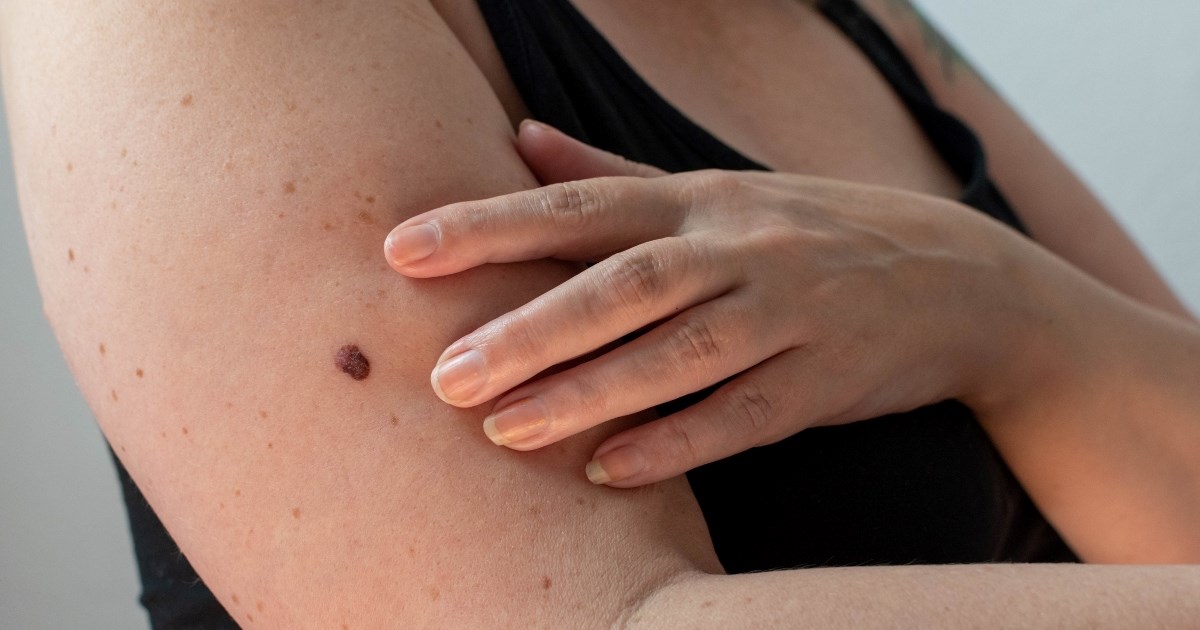 Znakovi raka kože na koje treba obratiti pažnju nakon 15 minuta provedenih na suncu