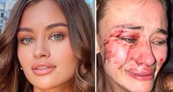 Lijepa manekenka objavila fotku krvavog lica: "Ne želim šutjeti, pretukli su me"