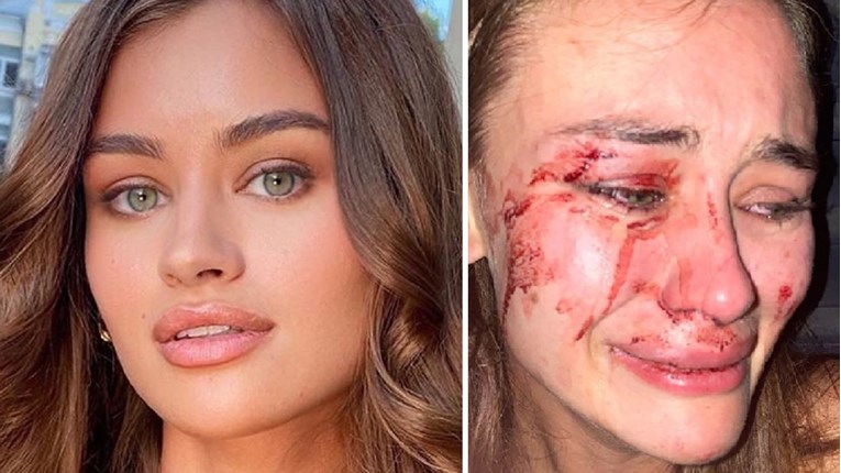 Lijepa manekenka objavila fotku krvavog lica: "Ne želim šutjeti, pretukli su me"