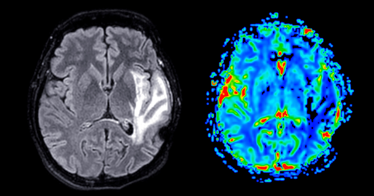 Dugoročni boravak u svemiru mijenja oblik i položaj mozga