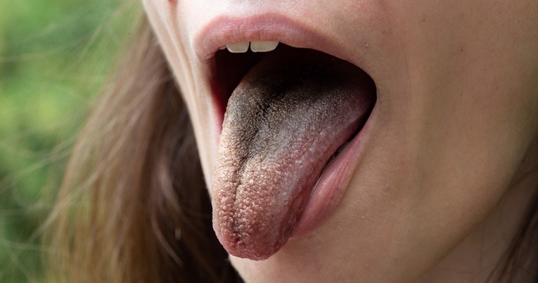 Dlakavi jezik, predoziranje vitaminom D,... Fascinantni medicinski slučajevi iz 2022.