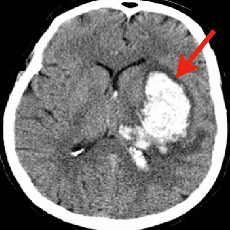 Moždani udar je među vodećim uzrocima smrti. Nađen mogući lijek