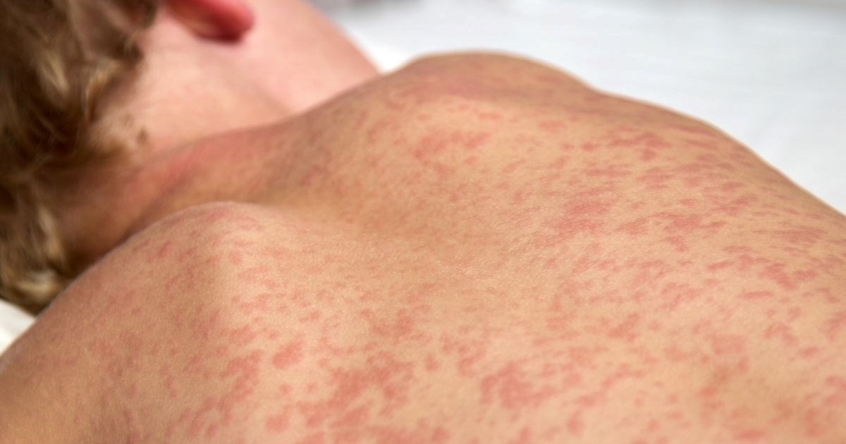 U Europi lani udvostručen broj slučajeva ospica, najviši u zadnjih 25 godina