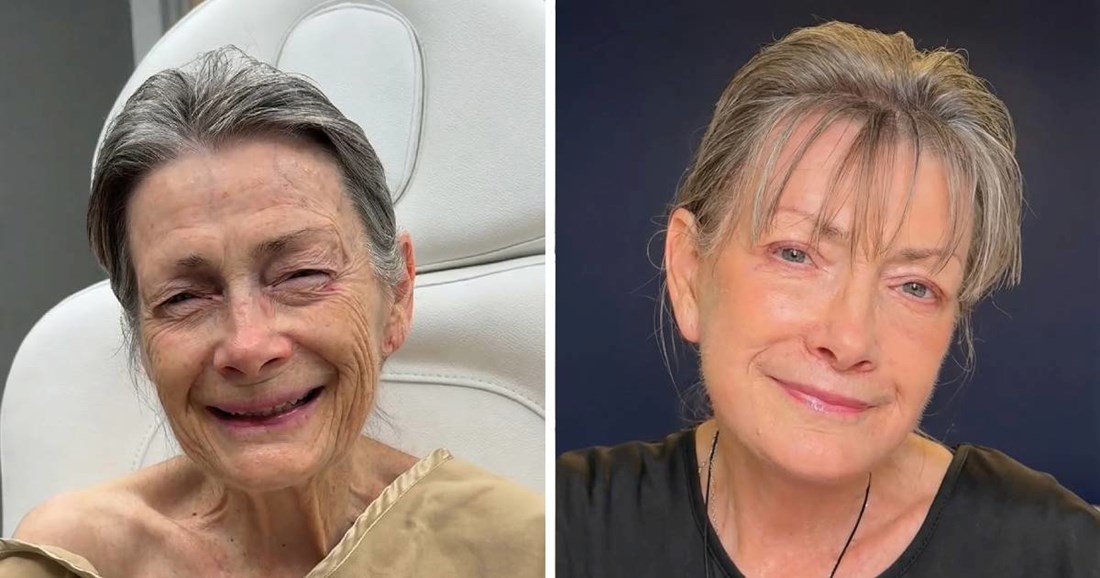 Plastični kirurg pomladio ženu (70) za 30 godina, internet oduševljen