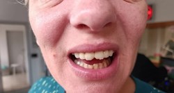 Pacijentica tvrdi da su joj razbili zube tijekom gastroskopije u KBC-u Split