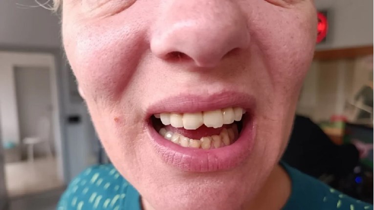 Pacijentica: Odlomili su mi zube tijekom gastroskopije u Splitu