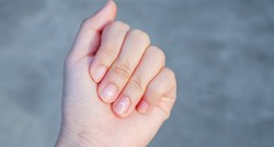 Ne ignorirajte ih: Bijele mrlje na noktima mogu biti znak ozbiljne bolesti