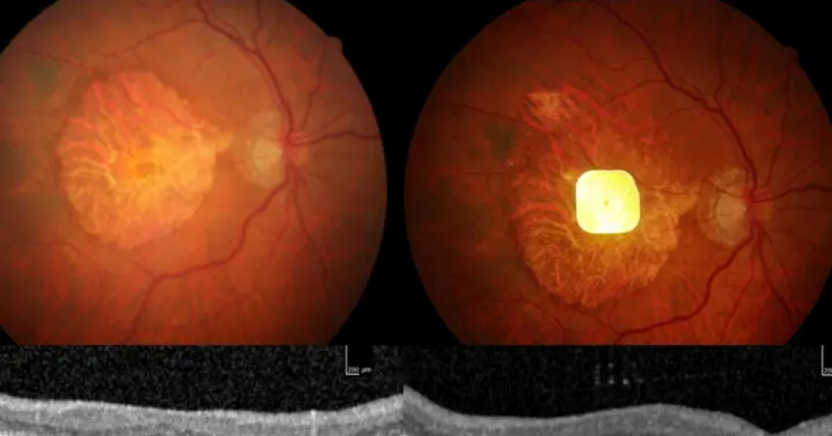 Znanstvenici razvili očni implantat koji slijepima vraća vid