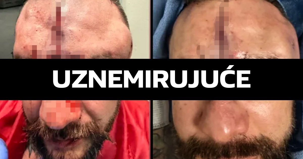 UZNEMIRUJUĆE Ovako izgleda lice poslije boksa bez rukavica
