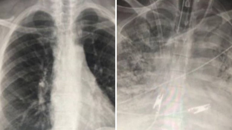 Ovo su snimke pluća pacijenata zaraženih koronavirusom. Jedan se cijepio, jedan nije