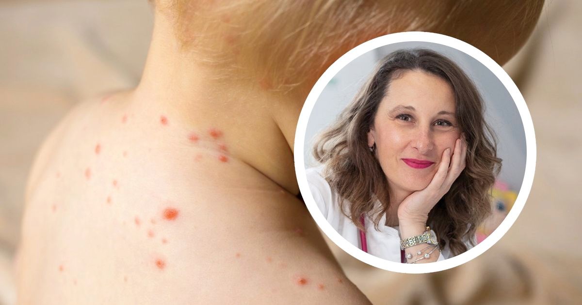 Zagrebačka pedijatrica: Prvi simptomi vodenih kozica često prođu nezapaženo