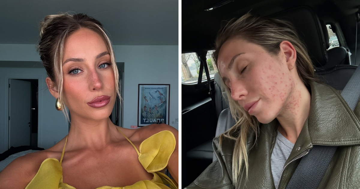 Alix Earle (24) pokazala kako izgleda bez šminke: "Prava koža je lijepa"