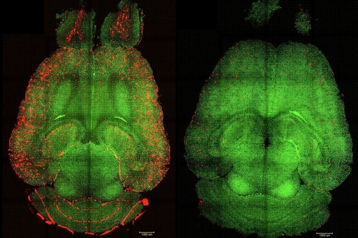 Znanstvenici razvili terapiju koja bi mogla značiti preokret u liječenju Alzheimera