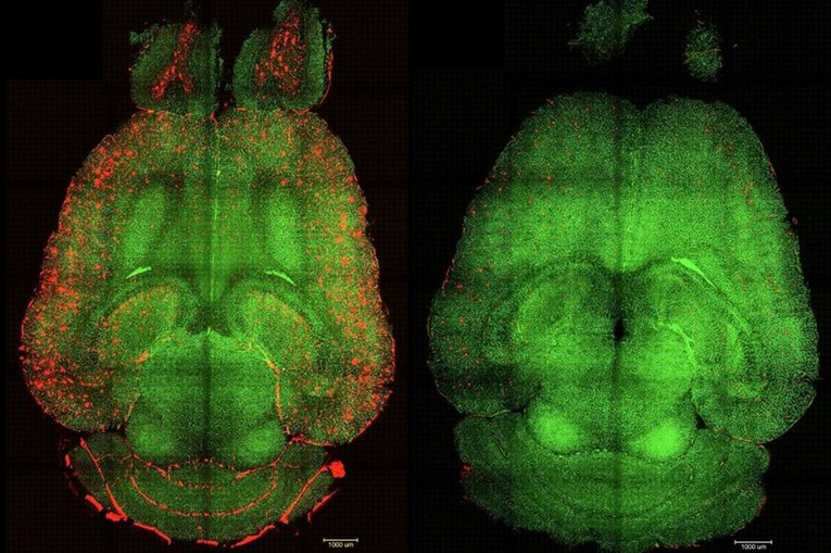 Znanstvenici razvili terapiju koja bi mogla značiti preokret u liječenju Alzheimera