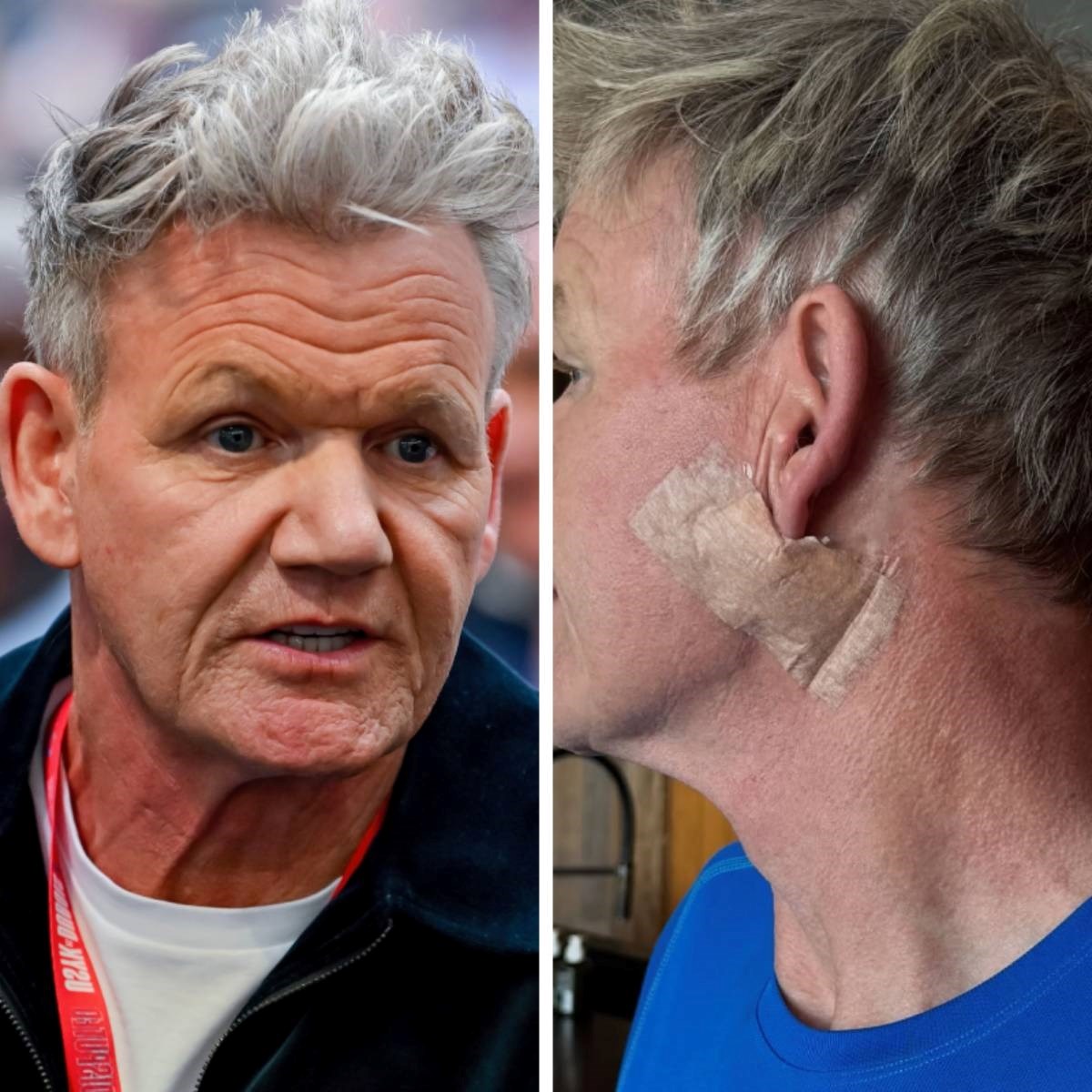 Gordon Ramsay objavio fotke nakon operacije: "Uklonili su mi karcinom"