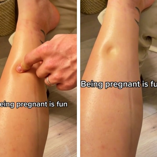 Mama podijelila bizaran simptom trudnoće i ostavila pratitelje u čudu: Što je ovo?