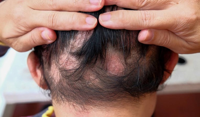 SAD odobrio novi lijek protiv alopecije: Može obnoviti do 80% kose na tjemenu