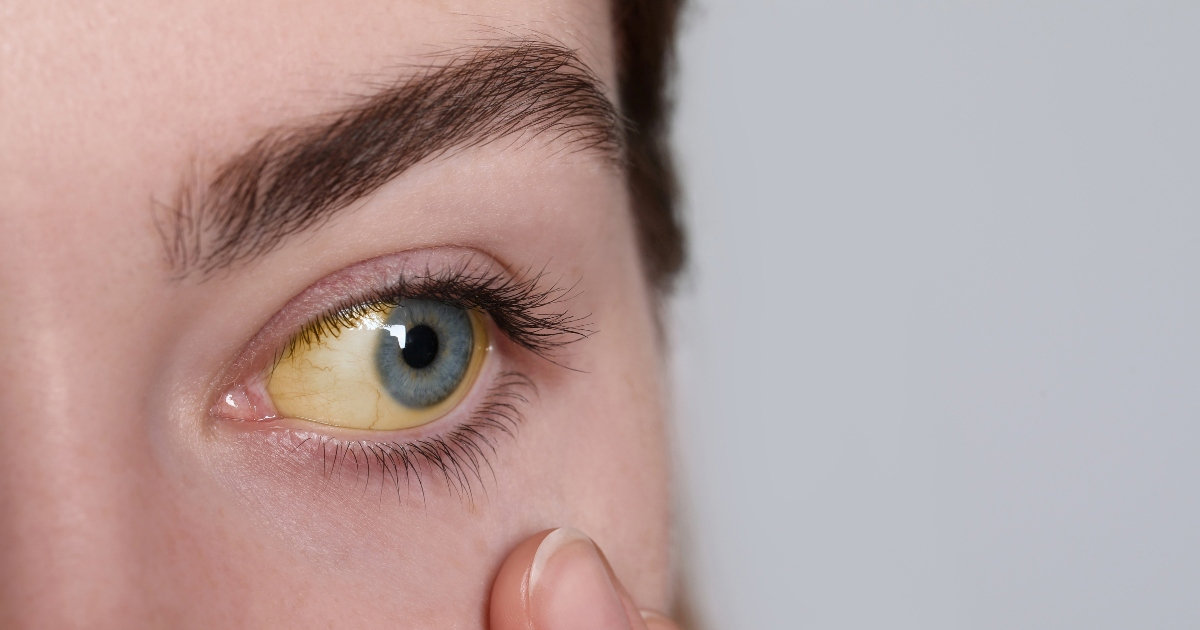 Kardiolog otkriva tri znaka da vam je kolesterol možda previsok