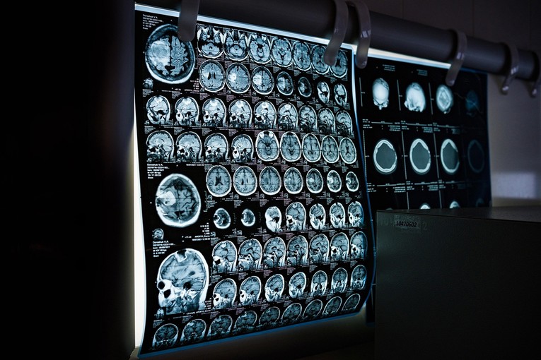 Obdukcija mozga otkrila zašto lijek protiv Alzheimera ne djeluje