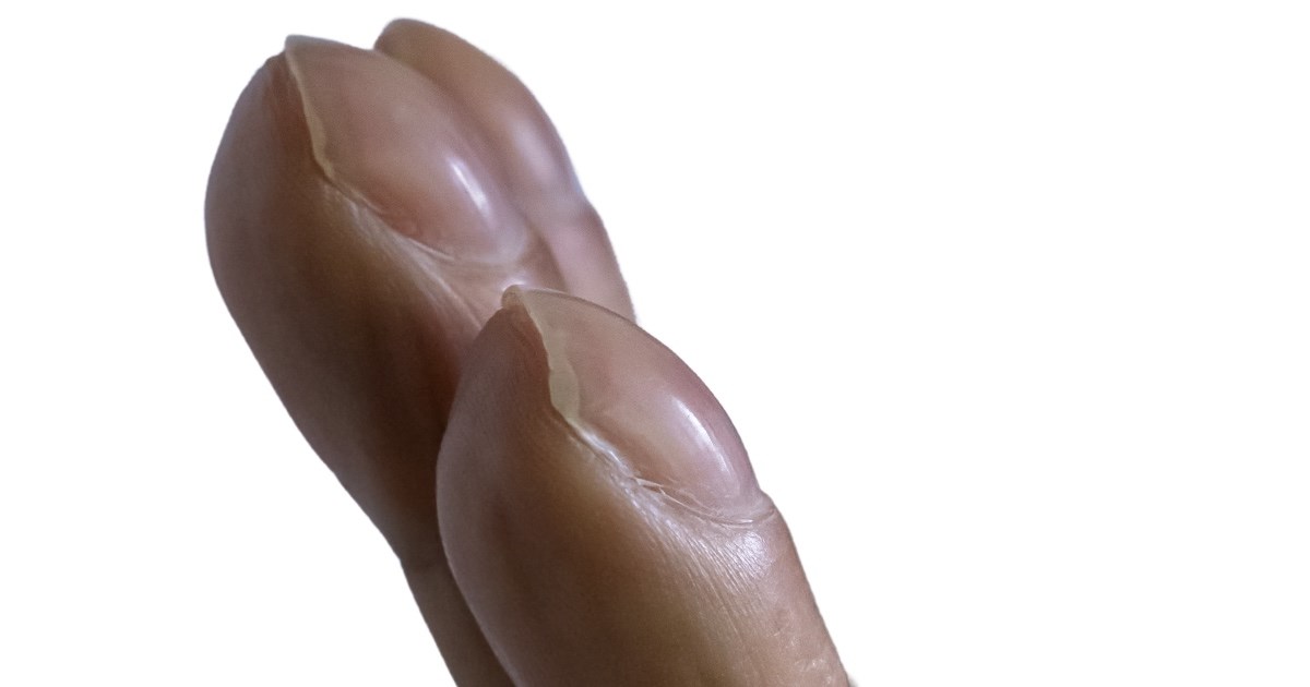 Tri znaka na koži koji bi mogli ukazivati na bolesti srca