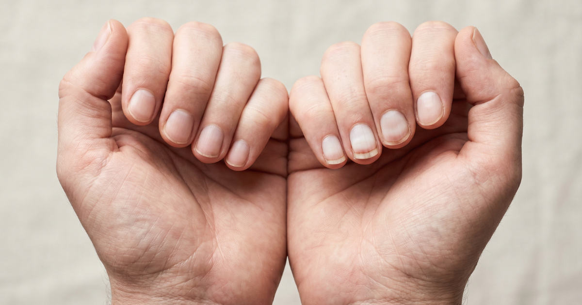 Promjena na noktima koju mnogi ignoriraju može ukazivati na zatajenje srca