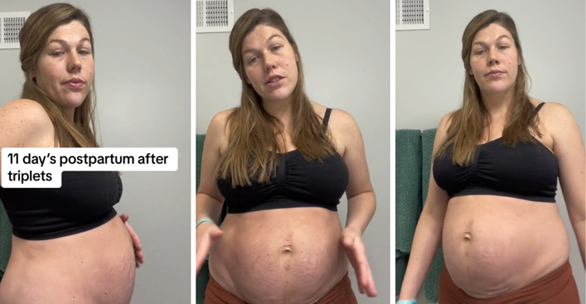 Mama koja je rodila trojke pokazala kako joj je izgledao trbuh nakon porođaja