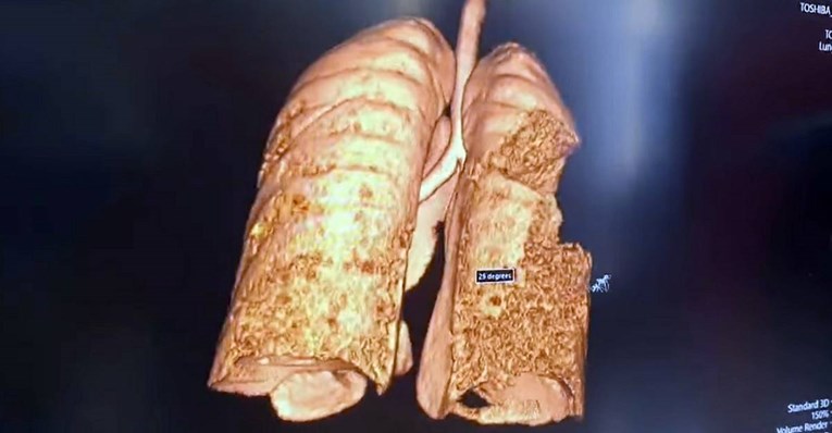 Pulmolog objavio snimku: Ovako nekad izgledaju pluća pogođena koronom