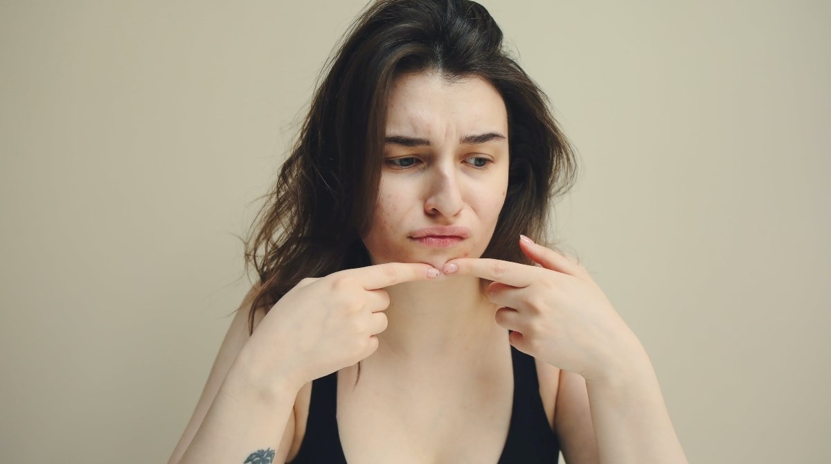 Dermatologinja otkriva zašto zimi pojačano izbijaju akne