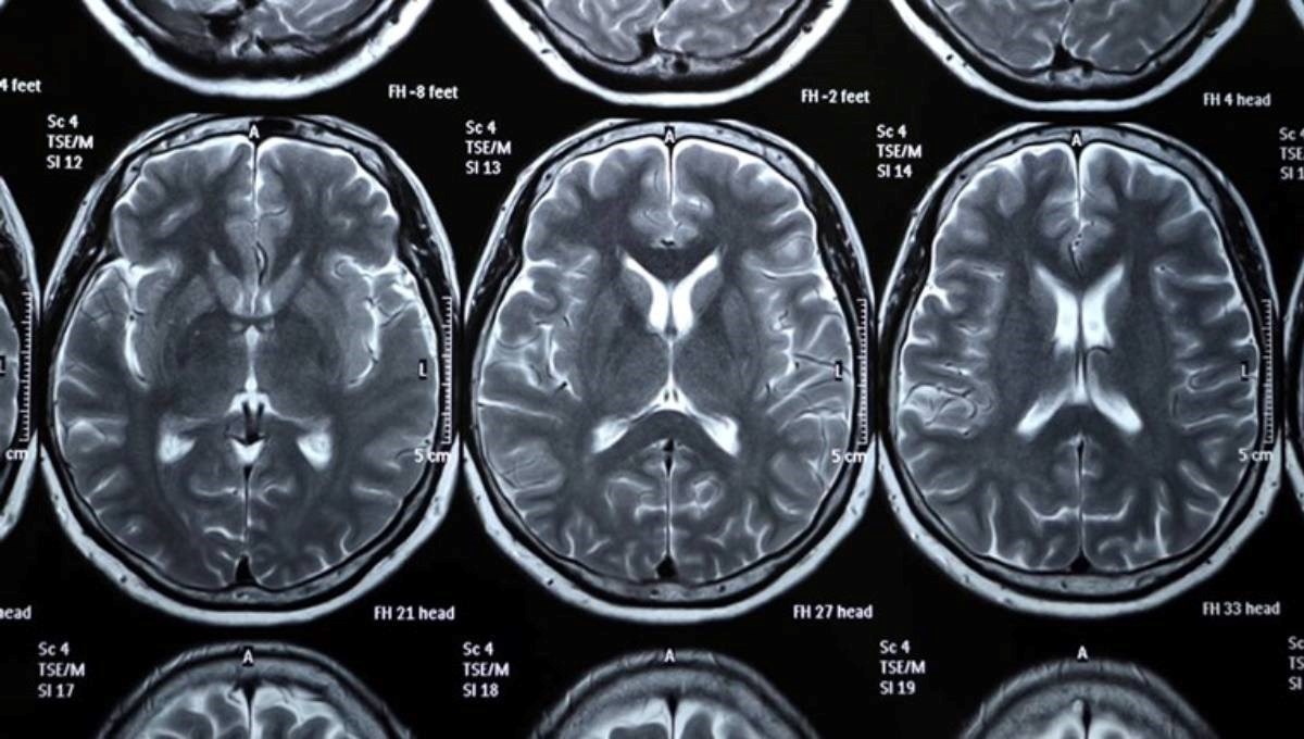 Mlađe generacije imaju veći mozak.  Je li to zdravije?