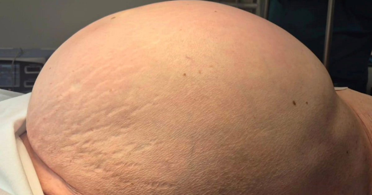 FOTO Tim na čelu s Darkom Milinovićem pacijentici odstranio tumor težak 36 kg