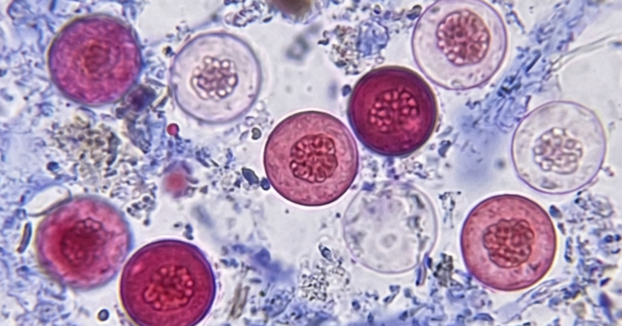 Dvije osobe umrle u epidemiji parazita u SAD-u, zaraženo više od 20.000 ljudi