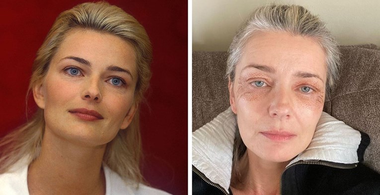 Slavna manekenka (55) pokazala ožiljke nakon estetskog tretmana: Želim biti lijepa