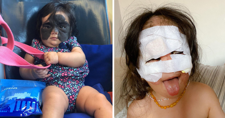 Nakon dvije godine operacija curici je uklonjen madež s lica s kojim je rođena