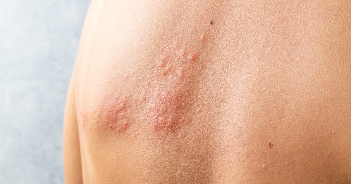 Herpes zoster: Ovo su tri rana simptoma zaraze virusom