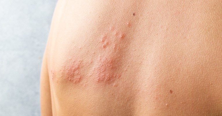 Herpes zoster: Ovo su tri rana simptoma zaraze virusom