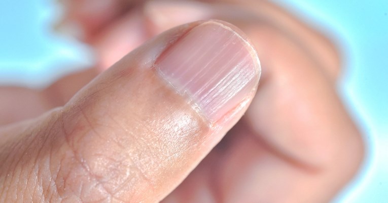 Ako imate vertikalne nabore na noktima, evo što to može značiti, tvrdi dermatologinja