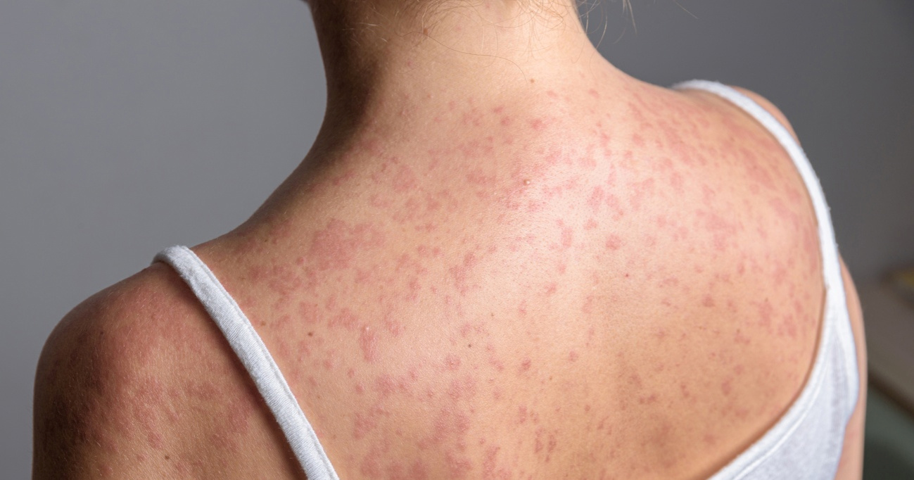 Raste broj slučajeva ospica u Europi