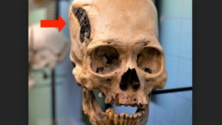 Misteriozna drevna lubanja s čudnim metalnim implantatom zbunjuje stručnjake
