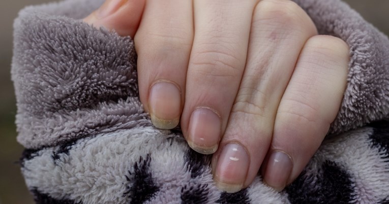 Ovo su razlozi zbog kojih biste mogli imati bijele mrlje na noktima