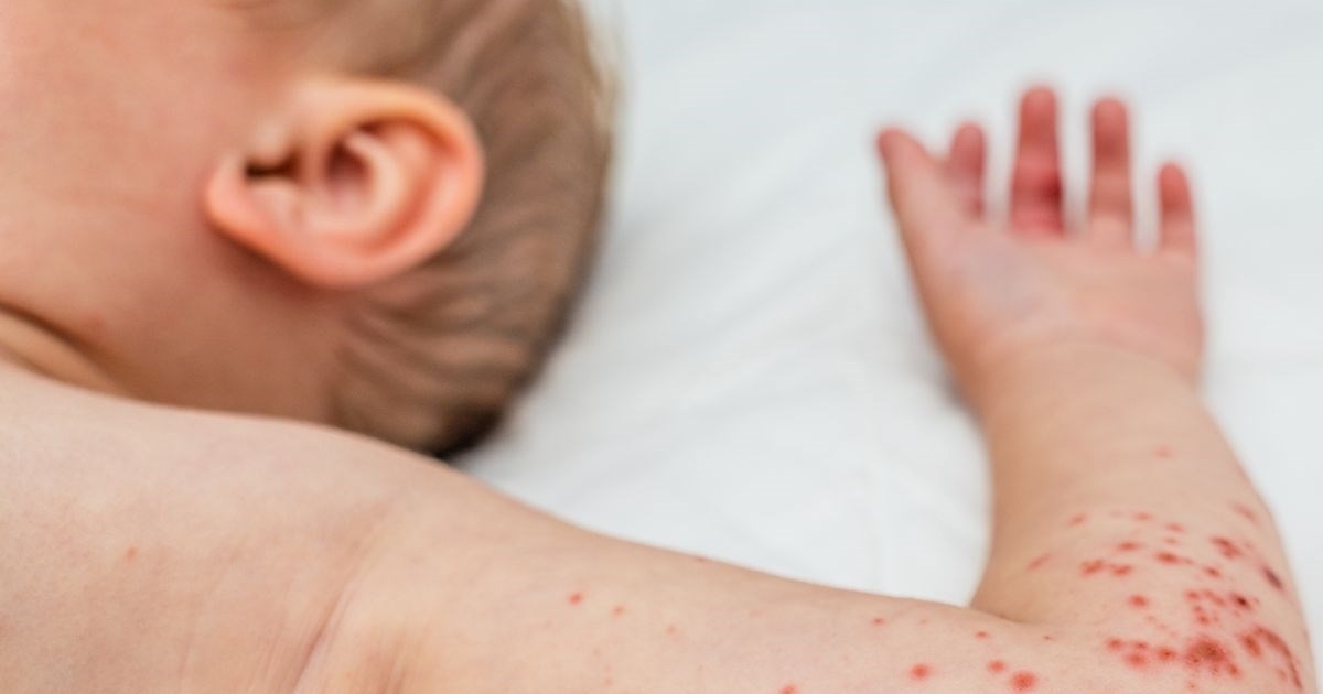 Umrla prva žrtva epidemije ospica u Teksasu, necijepljeno dijete