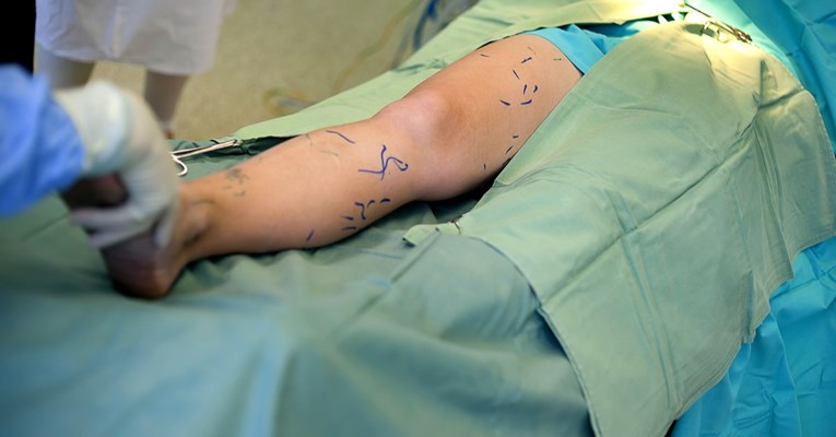 U Austriji amputirala krivu nogu pacijentu, sud je kaznio s 2700 eura