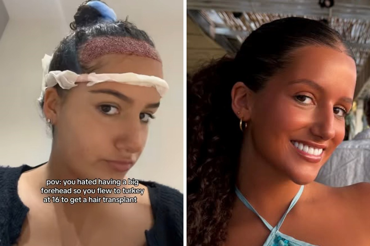 Tinejdžerica otputovala u Tursku na transplantaciju kose zbog niskog samopouzdanja