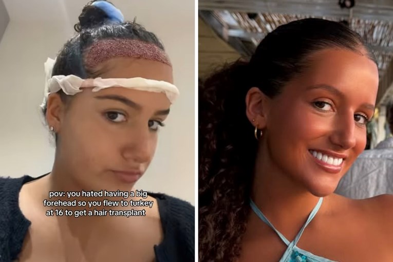 Šesnaestogodišnjakinja otišla u Tursku na transplantaciju kose zbog nesigurnosti