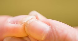 Neugodne probleme s noktima možete riješiti sastojcima koje već imate u kuhinji