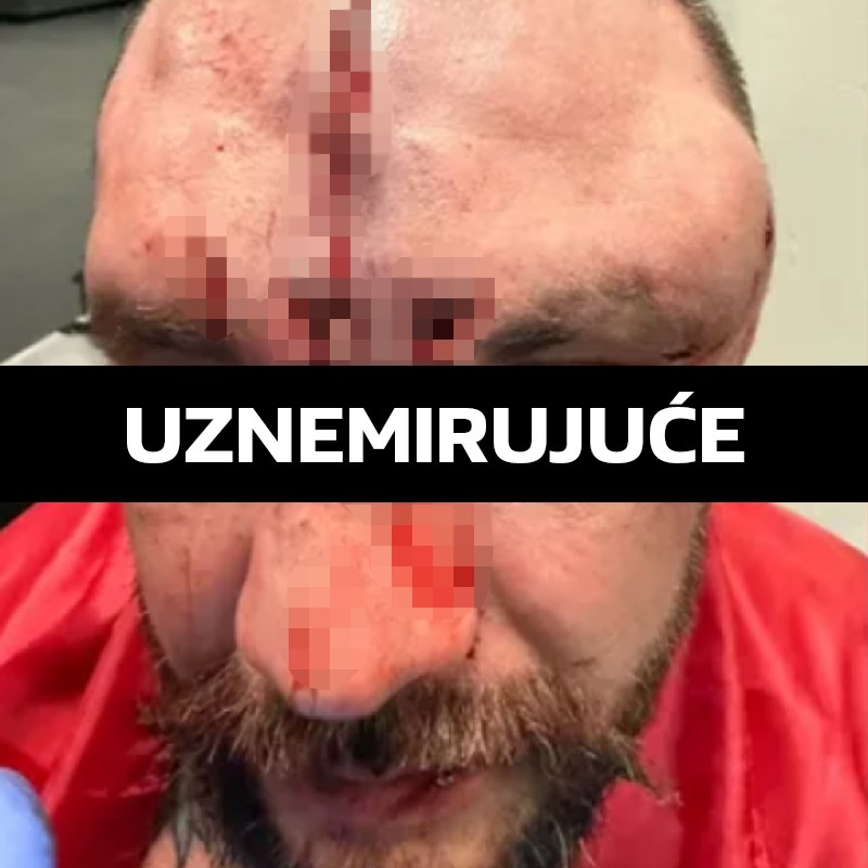 UZNEMIRUJUĆE Ovako izgleda lice poslije boksa bez rukavica