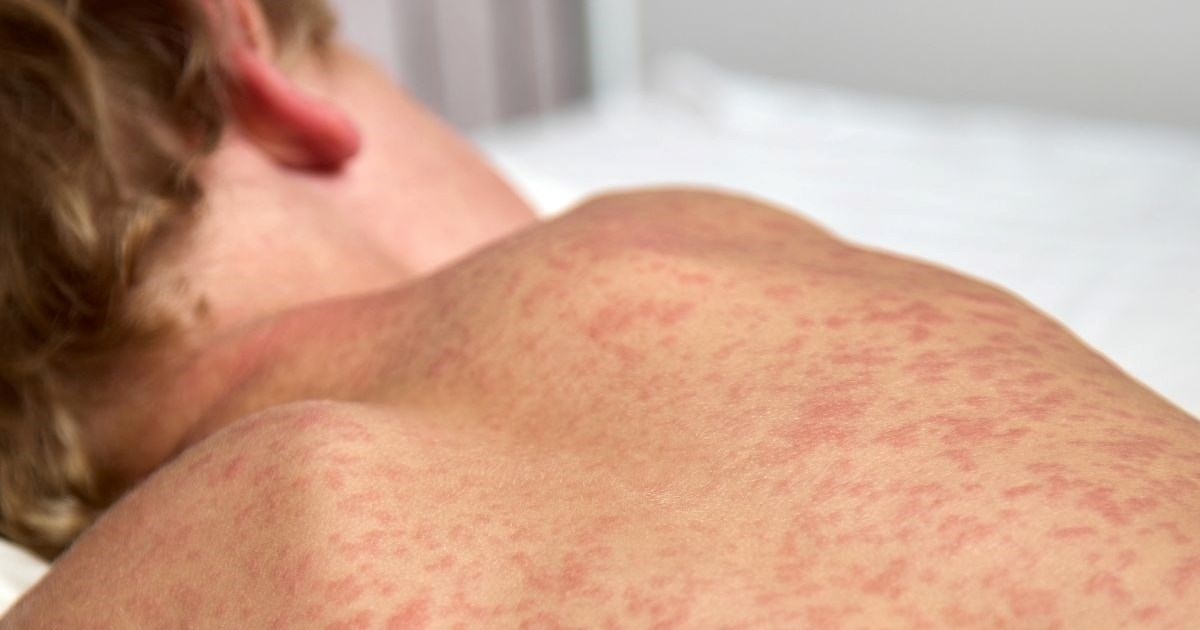 Ospice haraju Europom, najviše slučajeva u 25 godina. Britanci upozoreni uoči ljeta