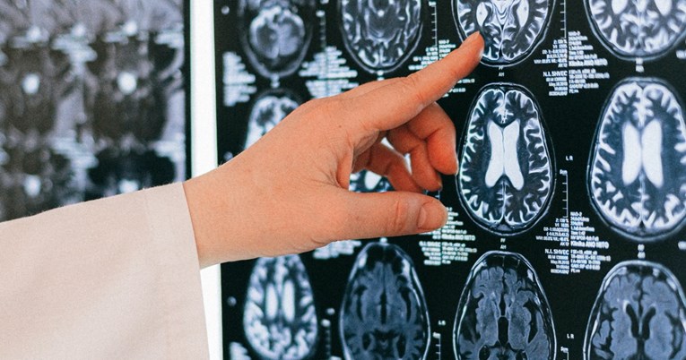 Simptomi tumora na mozgu nisu uvijek očiti. Evo kako ga je najlakše prepoznati