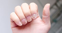 Uobičajeni simptomi koji mogu ukazivati na psorijazu, jedan se javlja na noktima