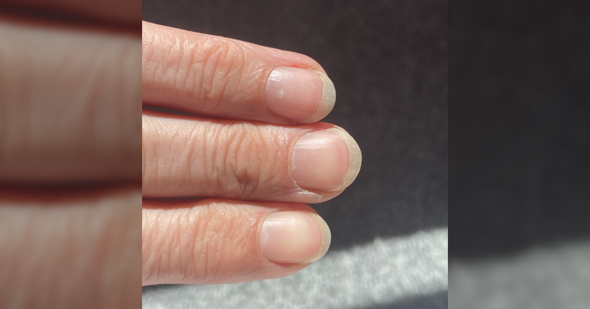 Simptom na noktima koji može biti rani znak zatajenja srca ili bolesti jetre